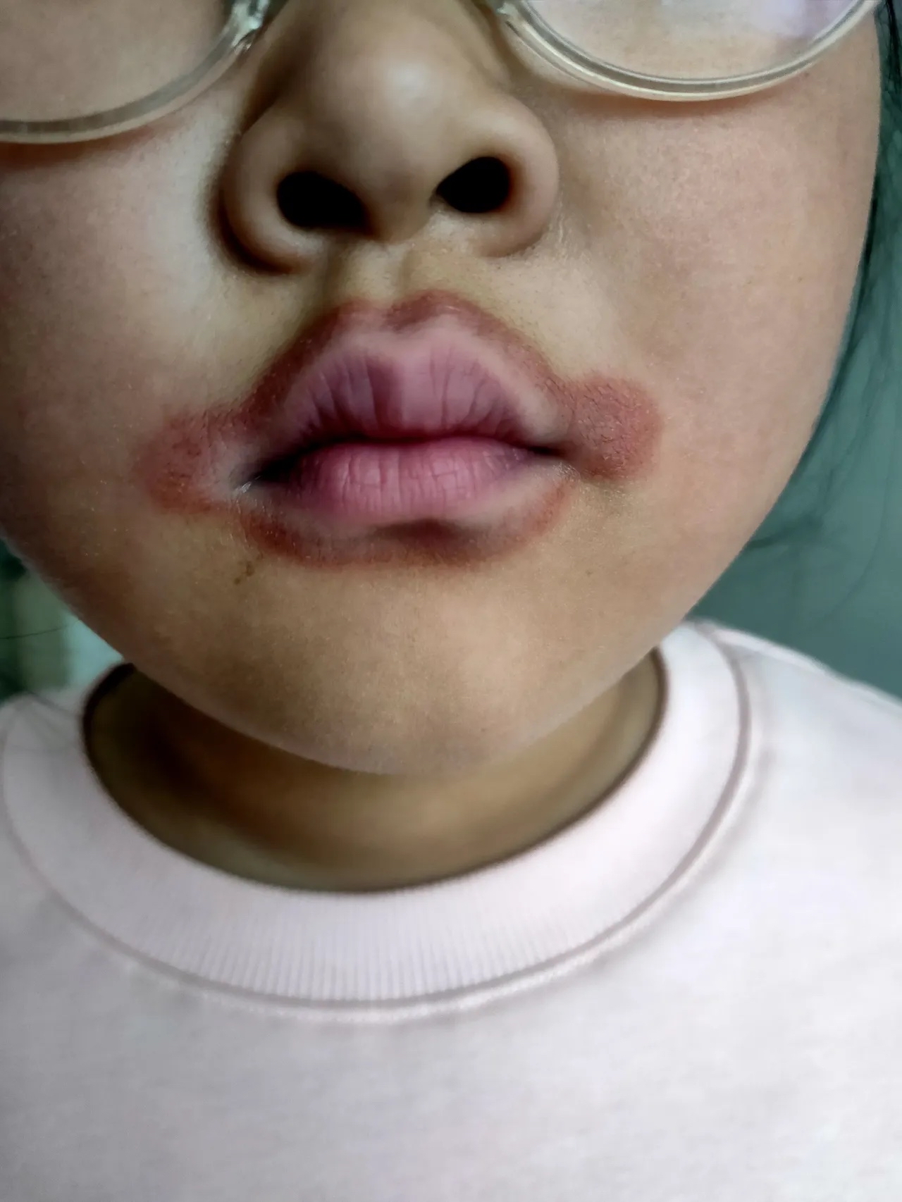 孩子嘴经常烂,用了很多办法,都没有见效,不知道是