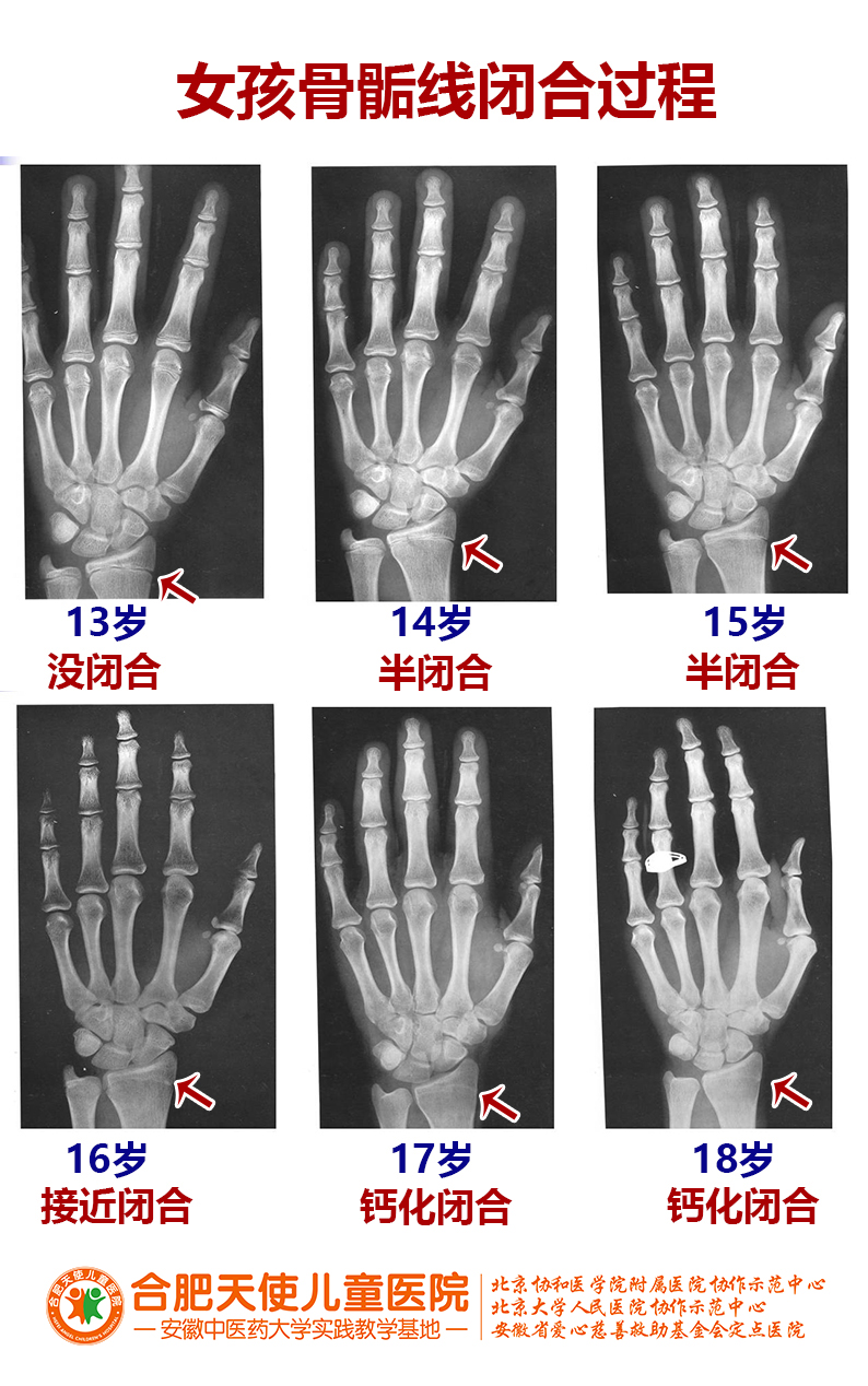 16岁骨骼线闭合图片