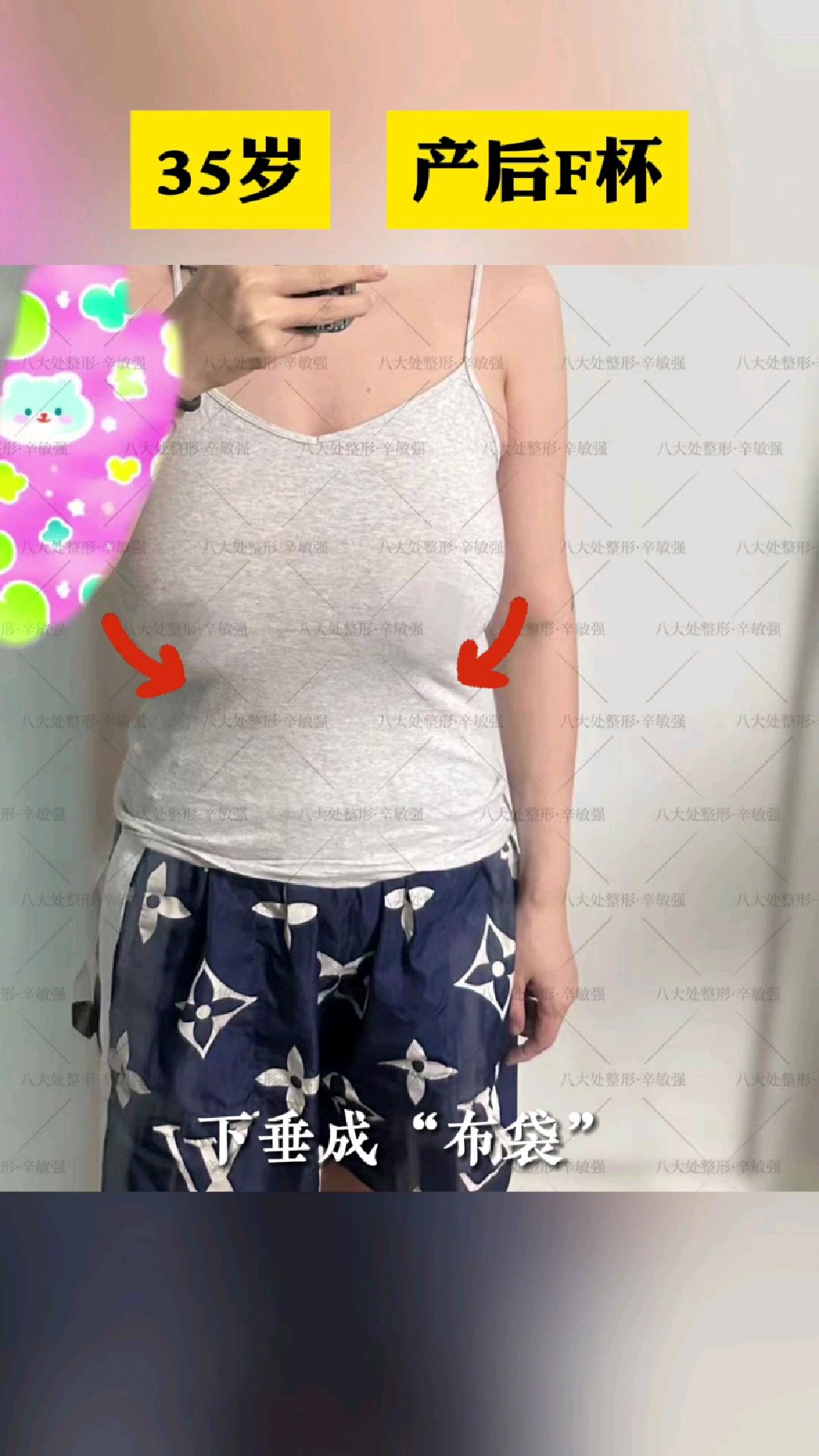 35岁产后f罩杯,几乎快垂到肚脐,缩胸后像变了个人!