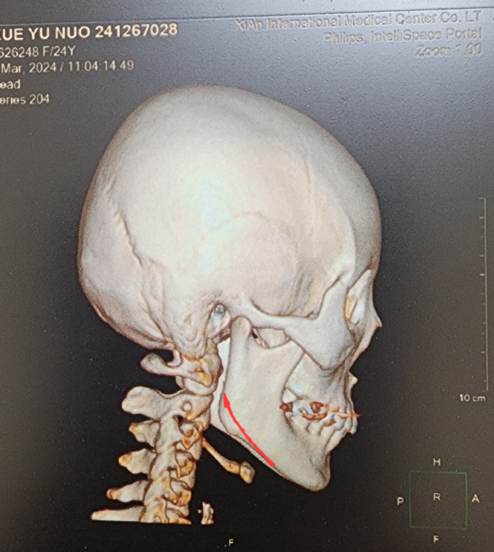 一台可以"不需要做"的手术
