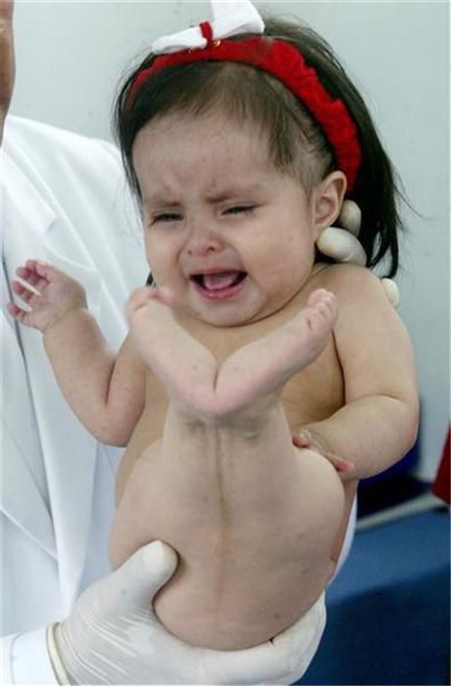 塞伦就是其中一位,她天生两腿内侧粘连,这是"美人鱼综合征"的表现