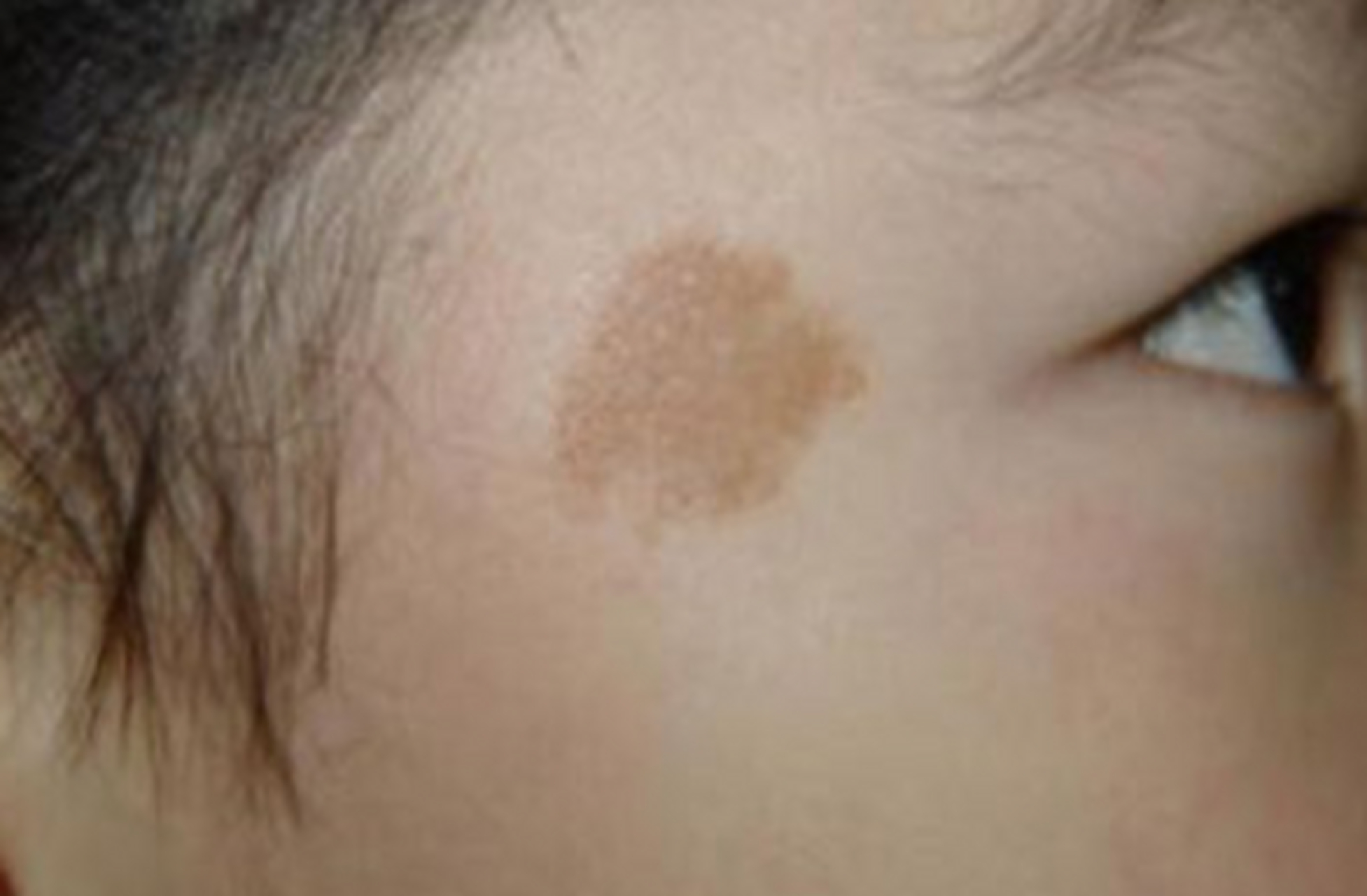 为什么宝宝会长咖啡斑?