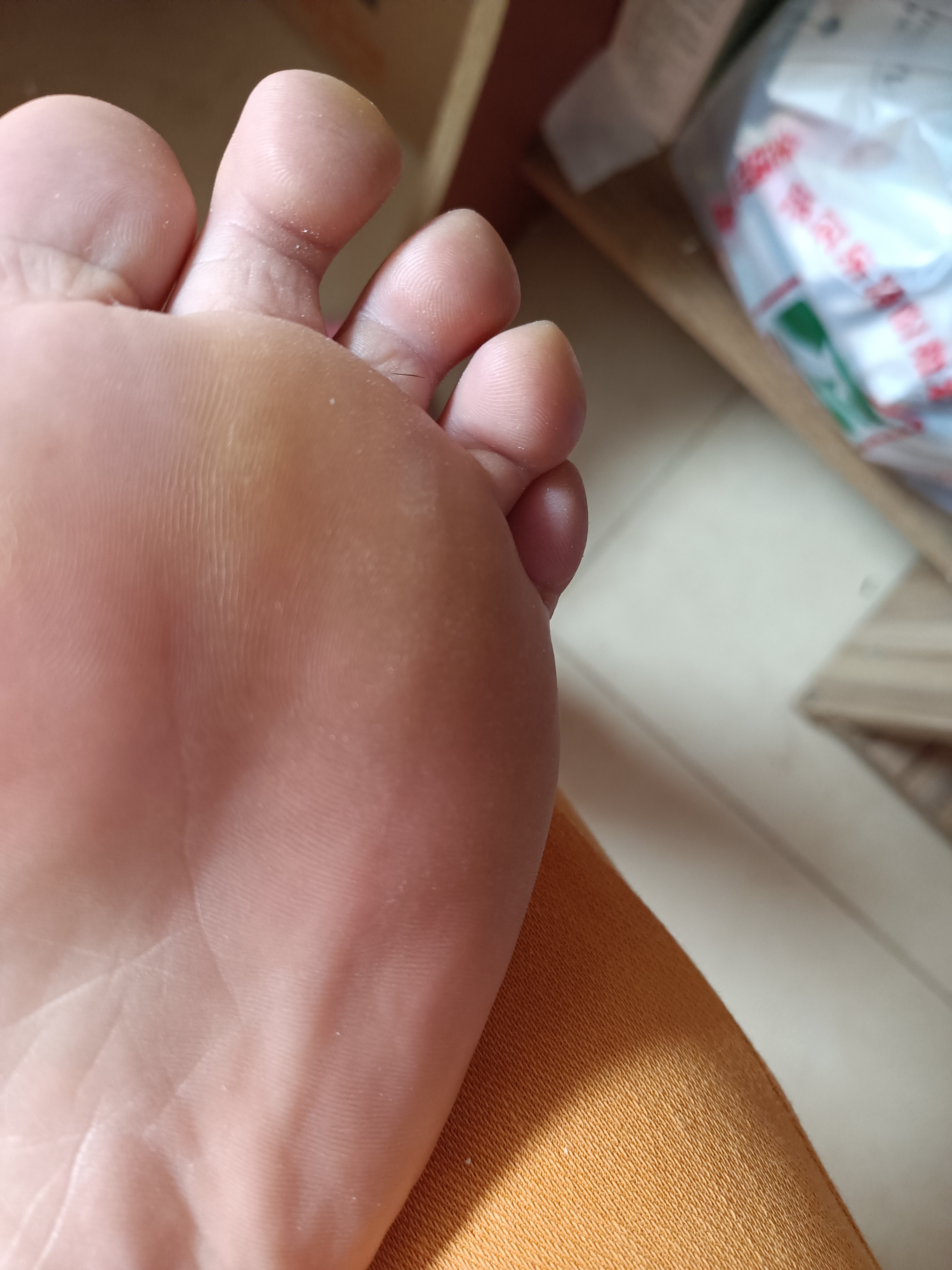 我的脚掌长茧子,可是我明明穿的是宽松的软平底鞋呀