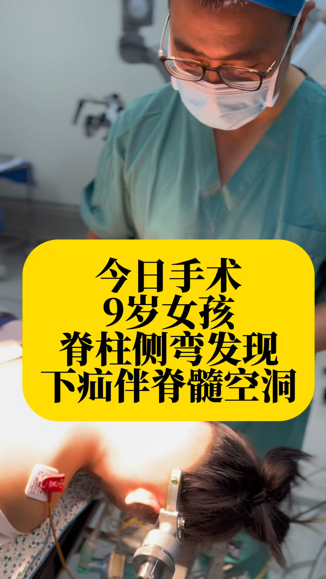 今日手术 9岁女孩 脊柱侧弯发现下疝伴脊髓空洞