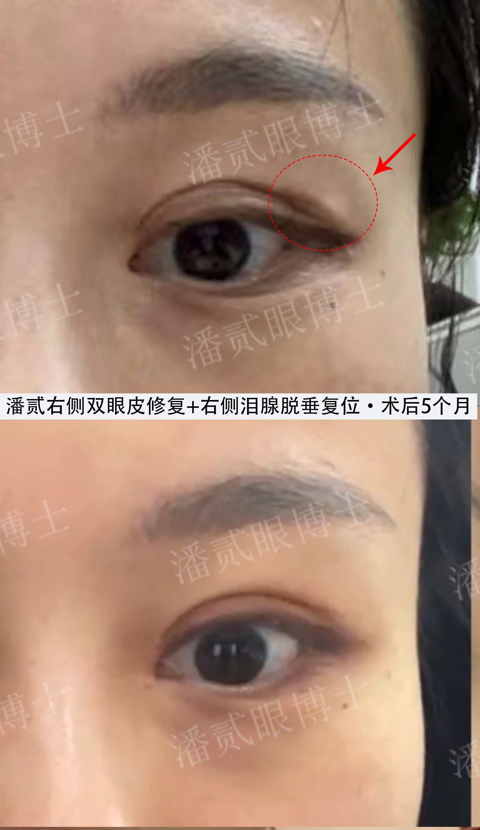 1次埋线 1次全切眼整形手术后,一侧眼尾鼓包还泪腺脱垂怎么办?
