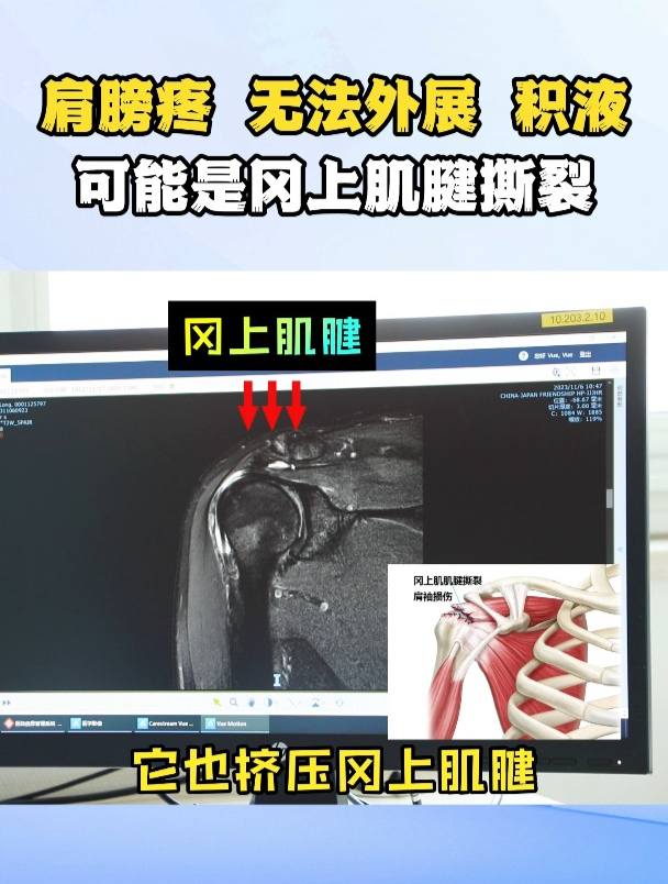 肩膀痛,无法外展,有积液,可能是冈上肌腱撕裂!