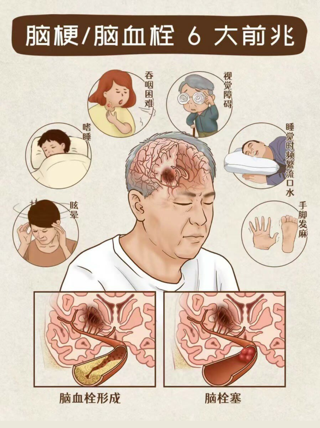 脑梗,脑血栓6大前兆  #脑梗塞# #中医# #健康# #脑血栓