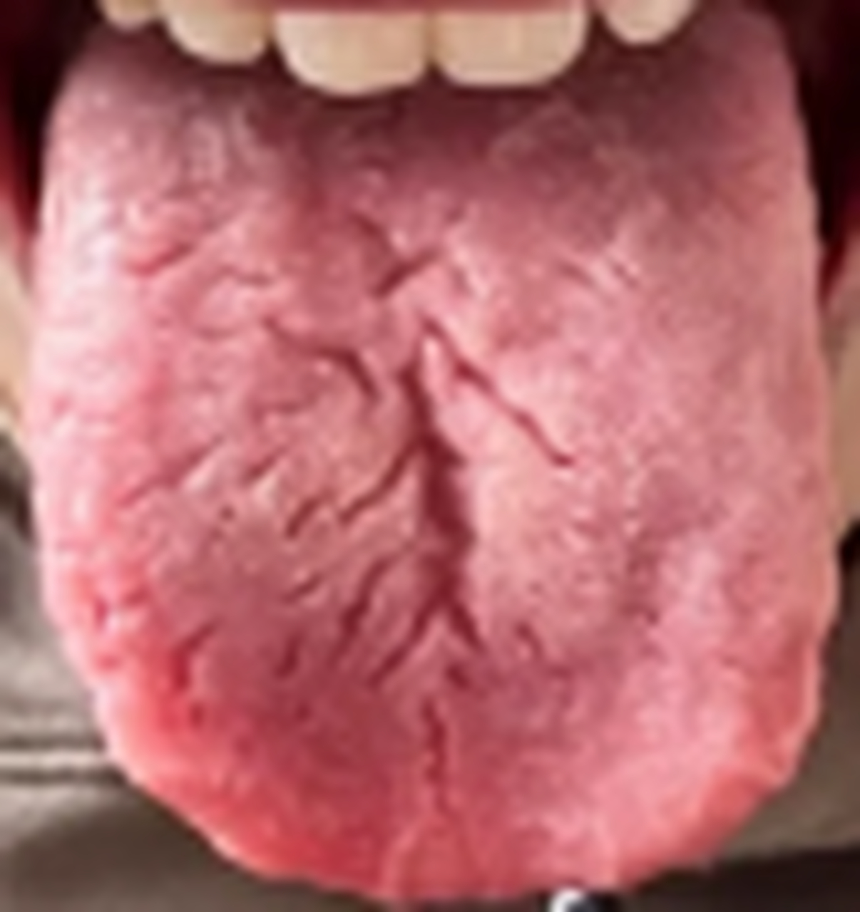 舌上都是裂纹,中间特别深大