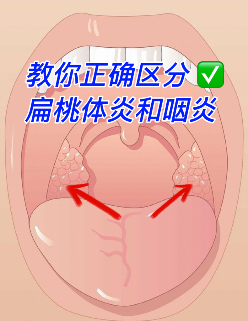 位置图片正常人的喉咙两侧图片扁桃体发炎的症状和表现扁桃体是指哪个