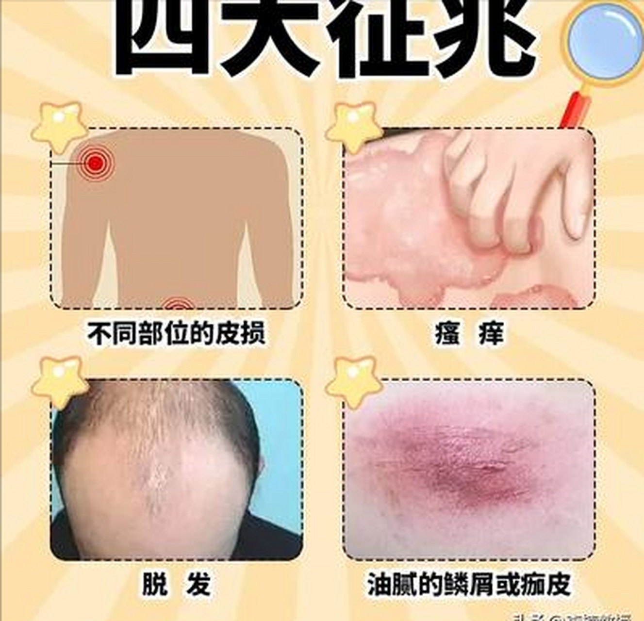 解析脂溢性皮炎的症状,病因以及治疗方法  脂溢性皮炎是一种常见的