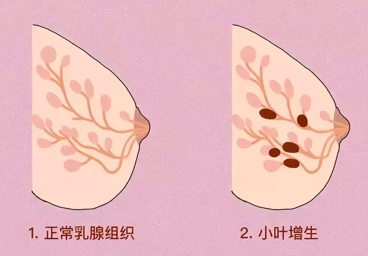 乳腺结节能摸出来吗图片