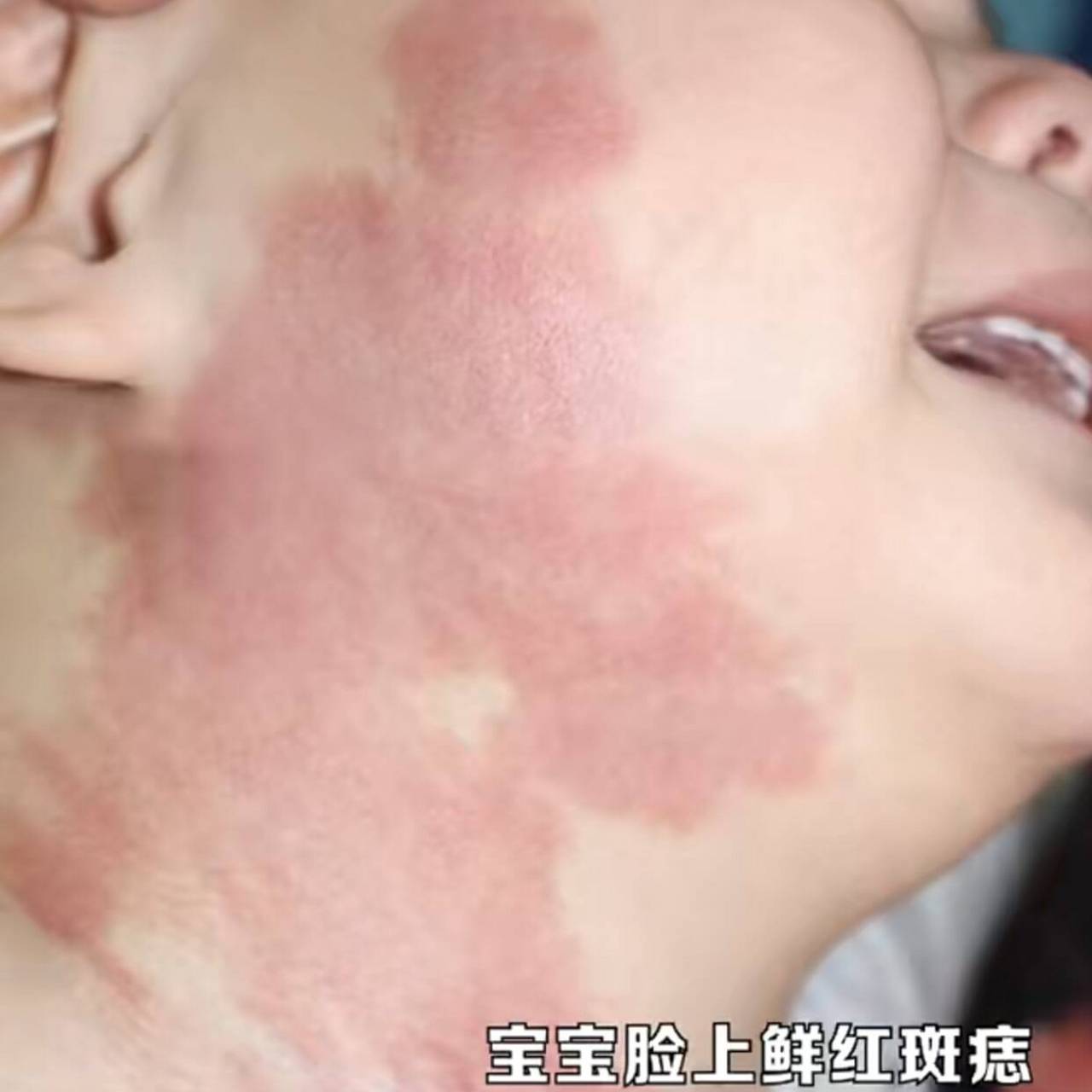 红胎记分三种,危害各不同  第一,鲑鱼斑--危险指数一颗星  也叫新生儿