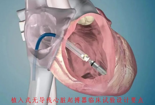 植入式无导线心脏起搏器临床试验设计要点