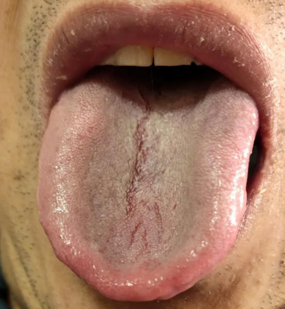 来看看这个舌头:  舌中裂纹延伸到舌根——脾肾两虚 舌边鼓胀