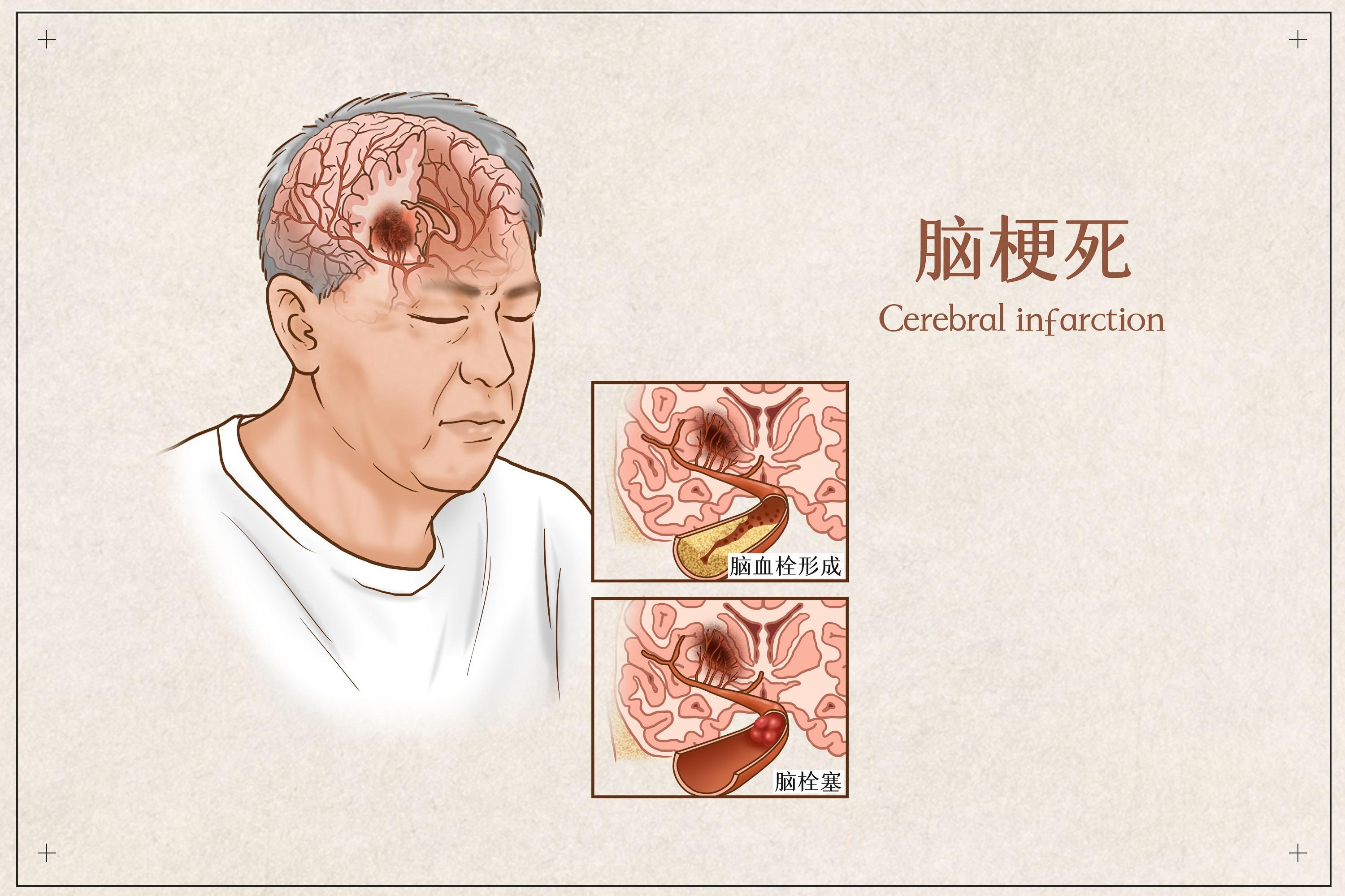 脑空气栓塞图片