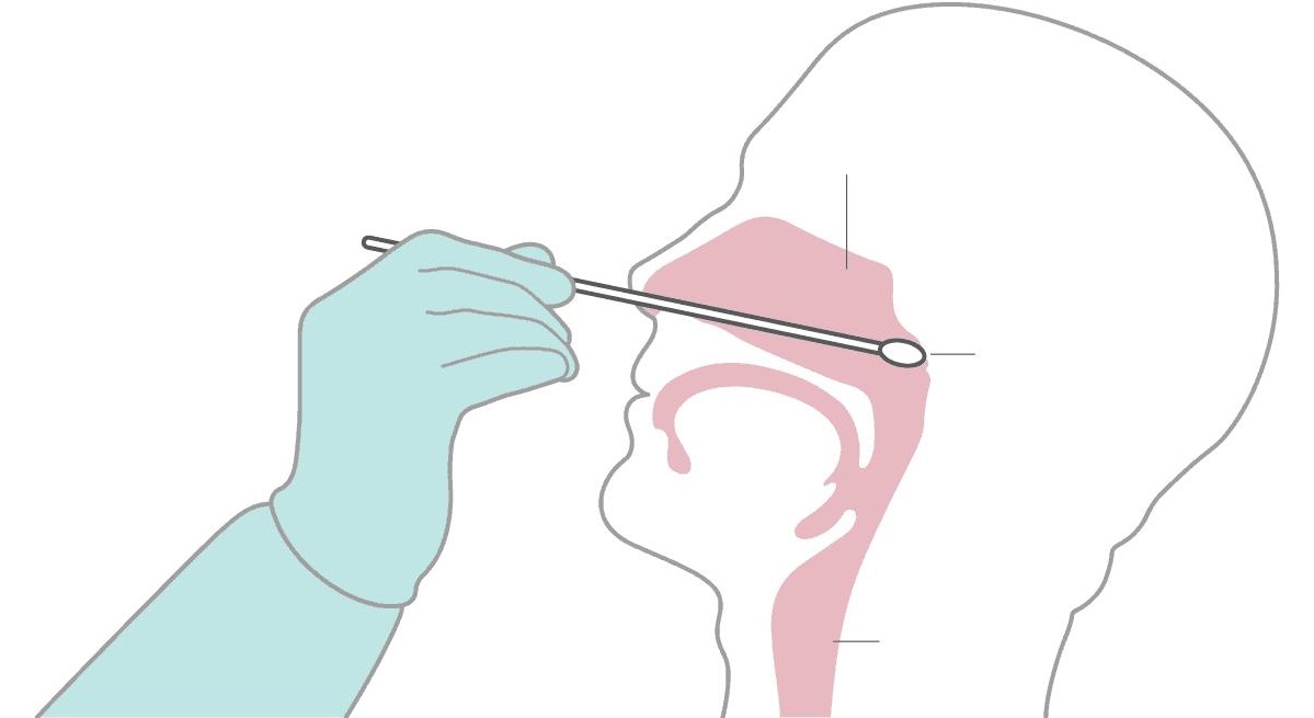 咽拭子取样部位图示图片