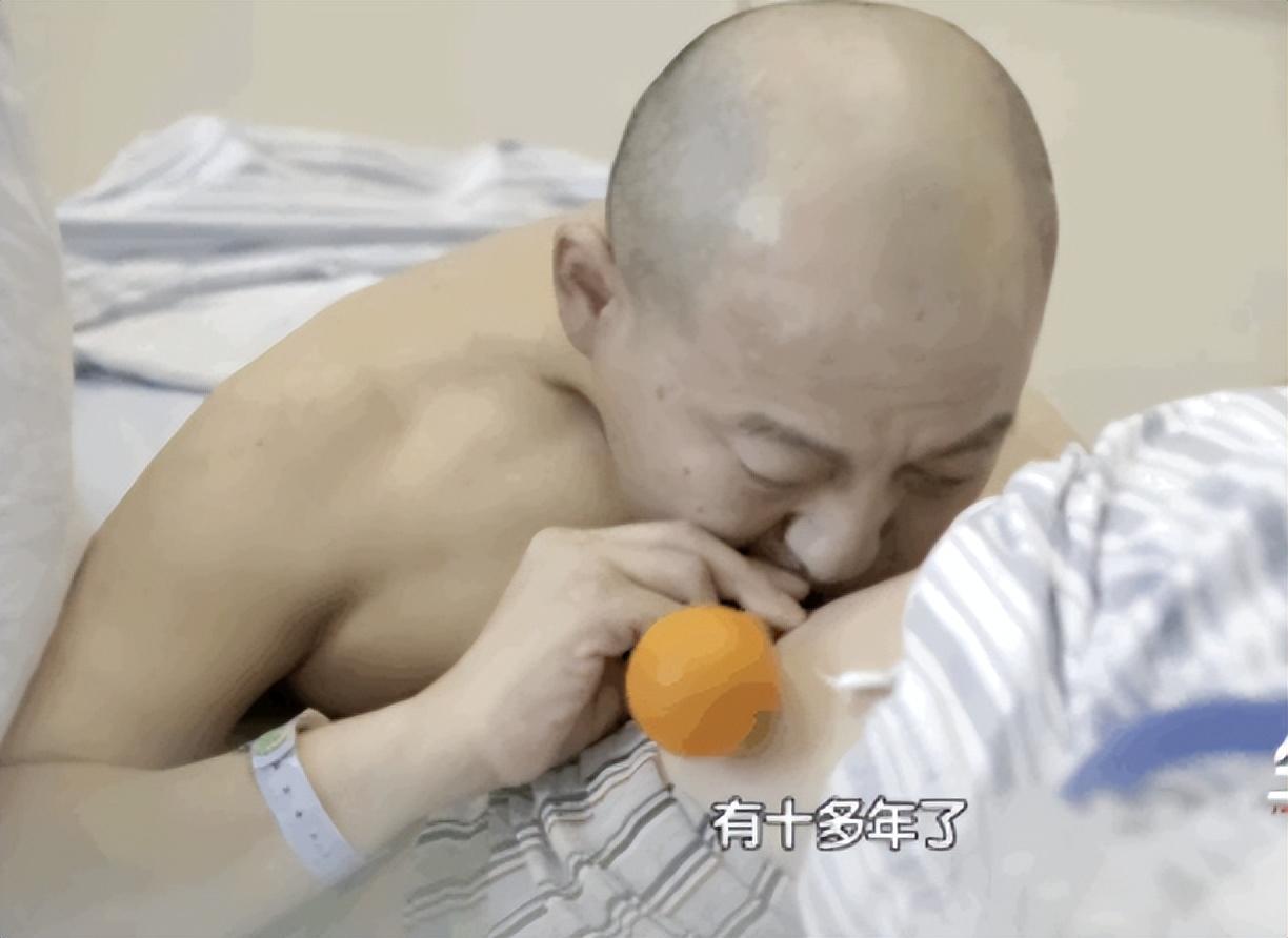 回顾折叠人李华骨头被敲断3次植入22颗钢钉如今重获新生