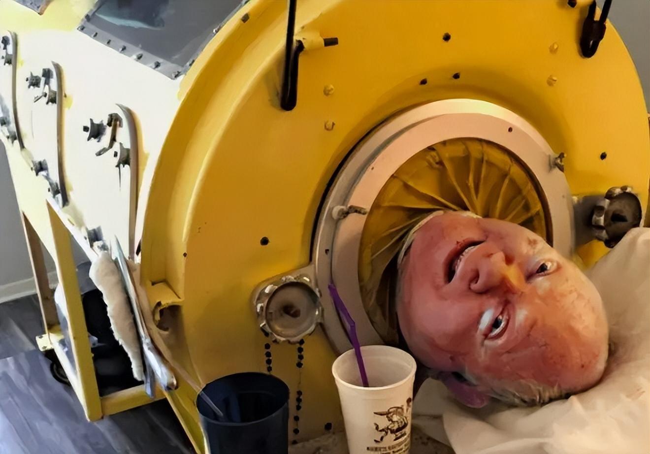 回顾世界最后一个铁肺人被困铁桶71年却靠毅力逆袭成为律师