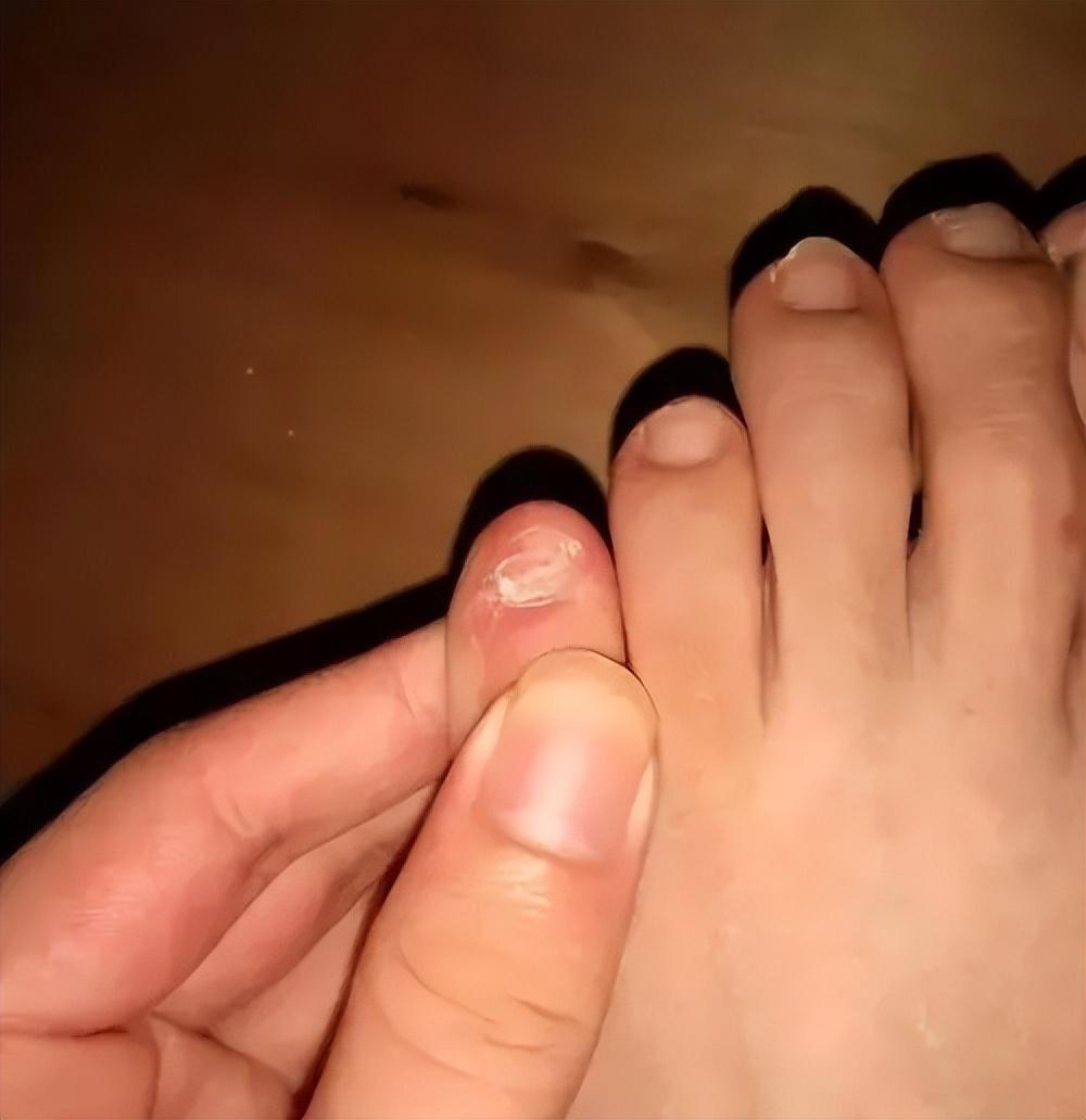 小脚趾指甲分成两瓣的人,到底有什么来头?是纯种汉族的证明吗?