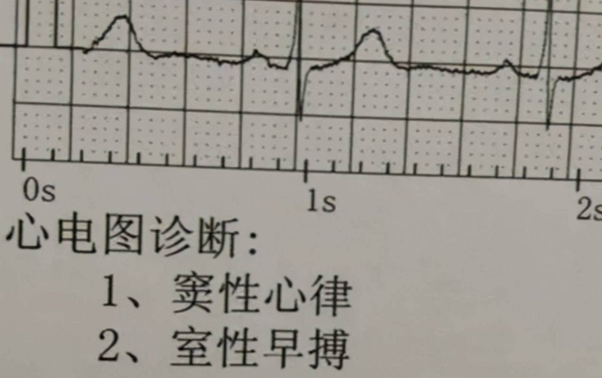 早搏的心电图表现图片