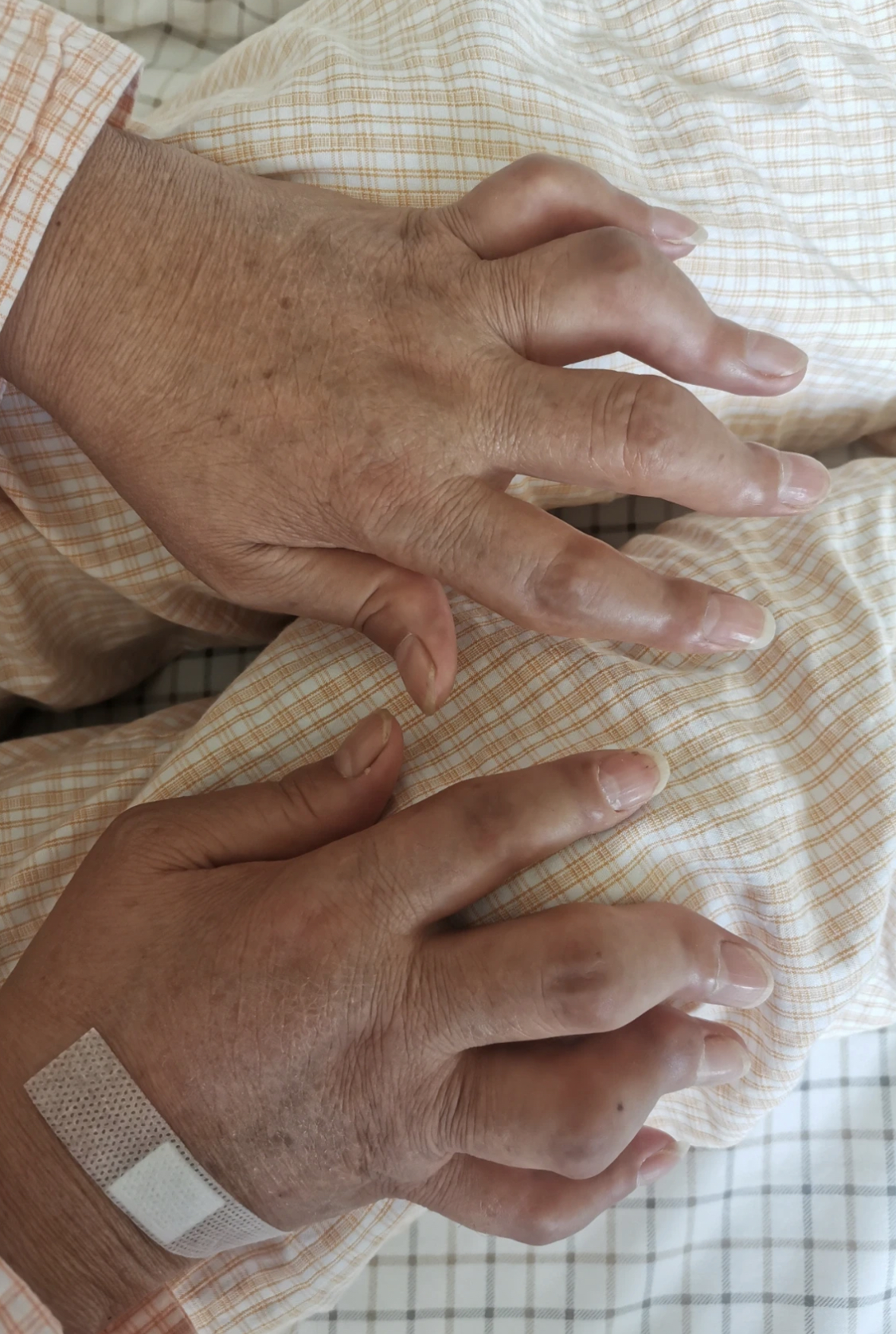 今天,我想和大家分享一个我在临床实践中遇到的典型病例