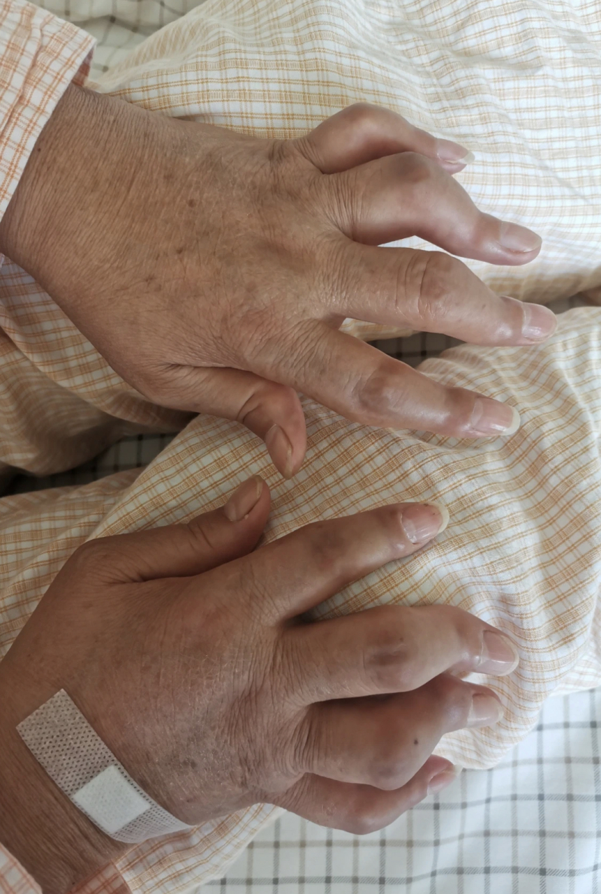 今天,我想和大家分享一个我在临床实践中遇到的典型病例——"天鹅颈手