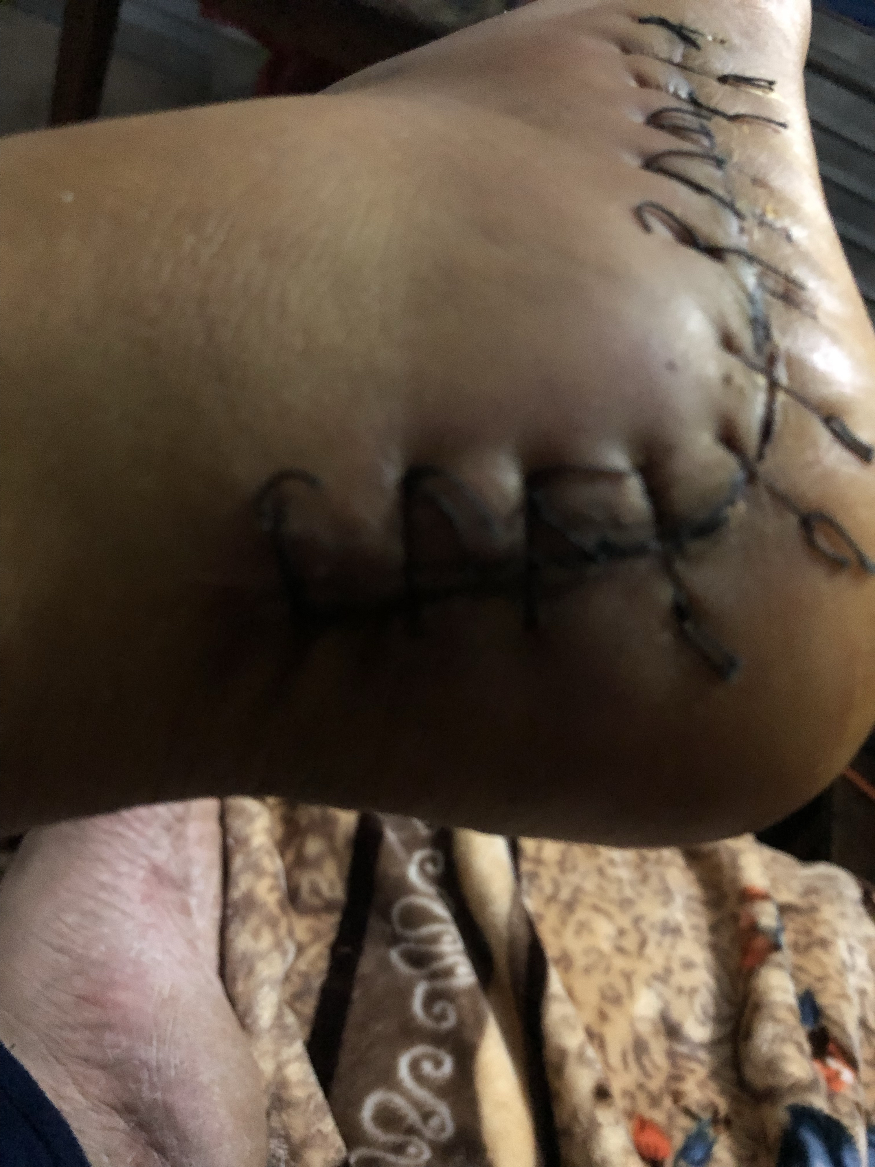 脚跟骨取钢板一个星期有没有懂行的大哥看看我这刀口愈合的好吗