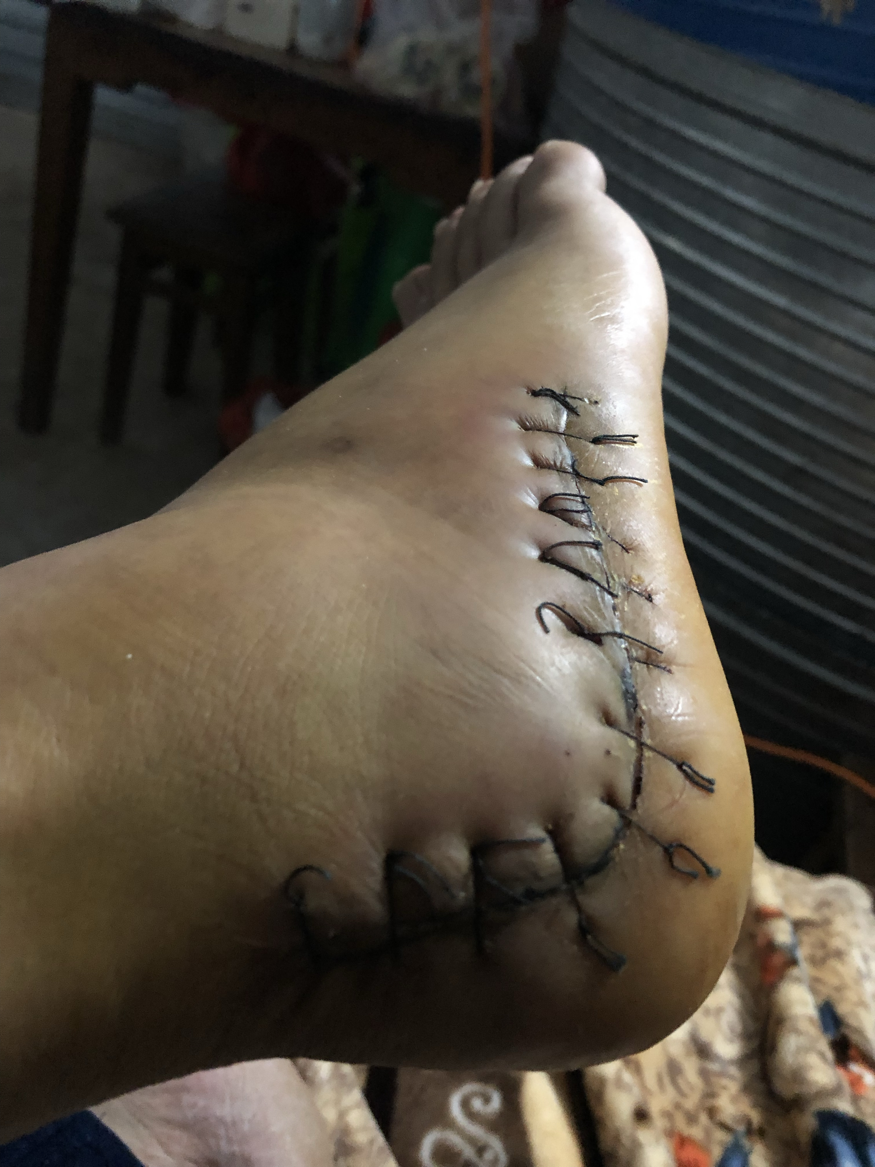 脚跟骨取钢板一个星期有没有懂行的大哥看看我这刀口愈合的好吗