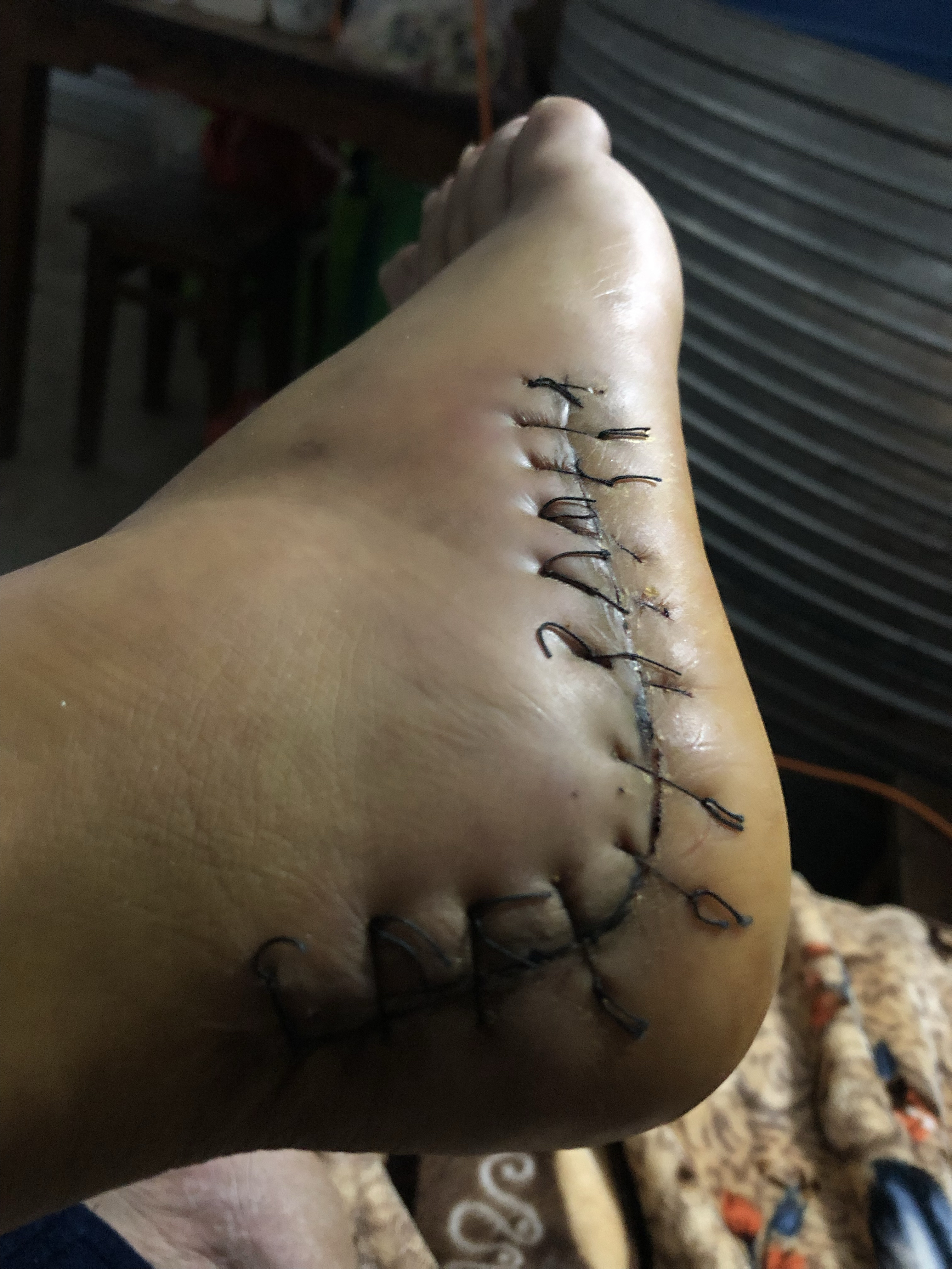 脚跟骨取钢板一个星期有没有懂行的大哥看看我这刀口愈合的好吗