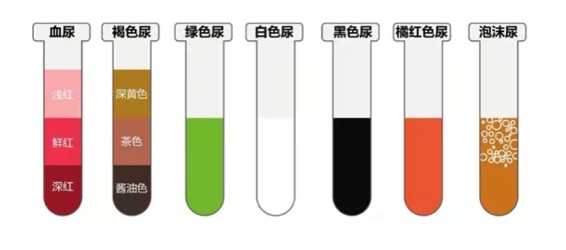 尿中有泡沫?小心蛋白尿