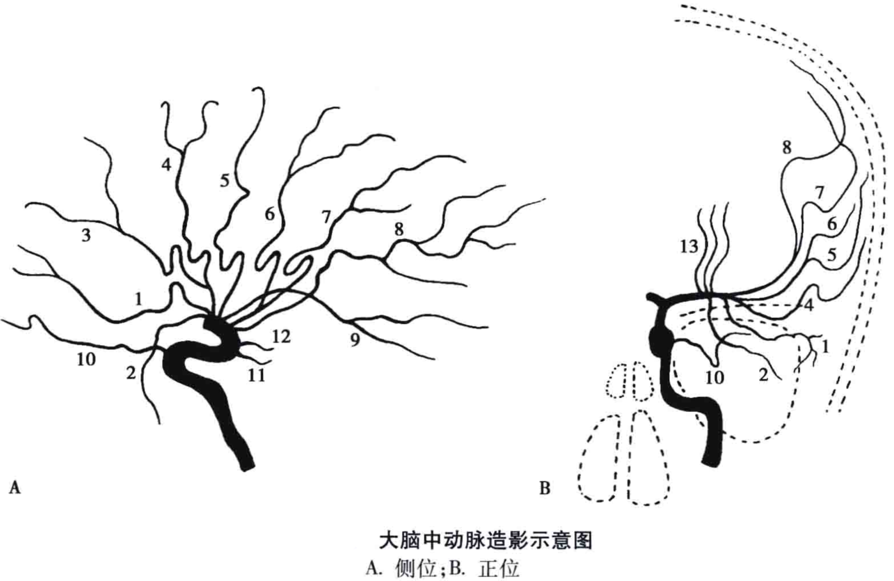 外侧豆纹动脉图片