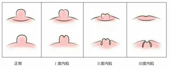 乳头发育突出图片