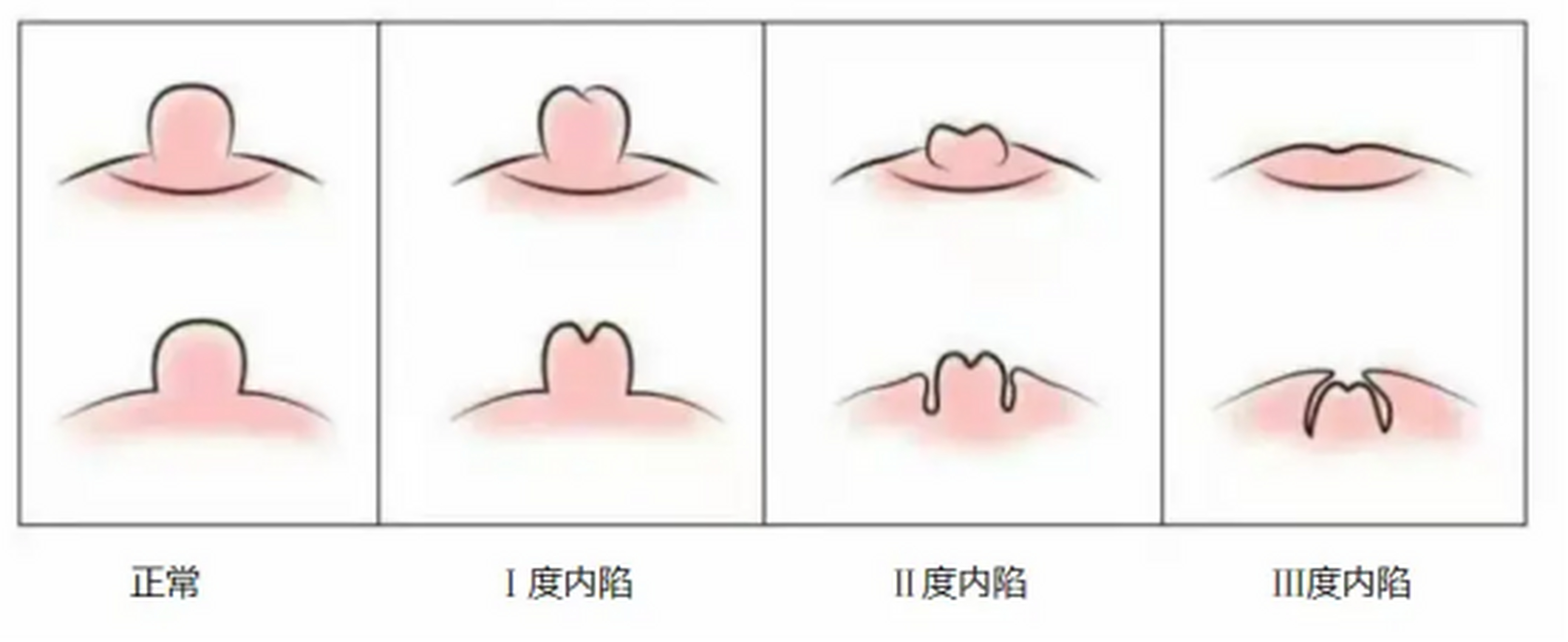 孕妇乳头内陷图图片