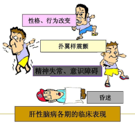 肝性脑病漫画图片