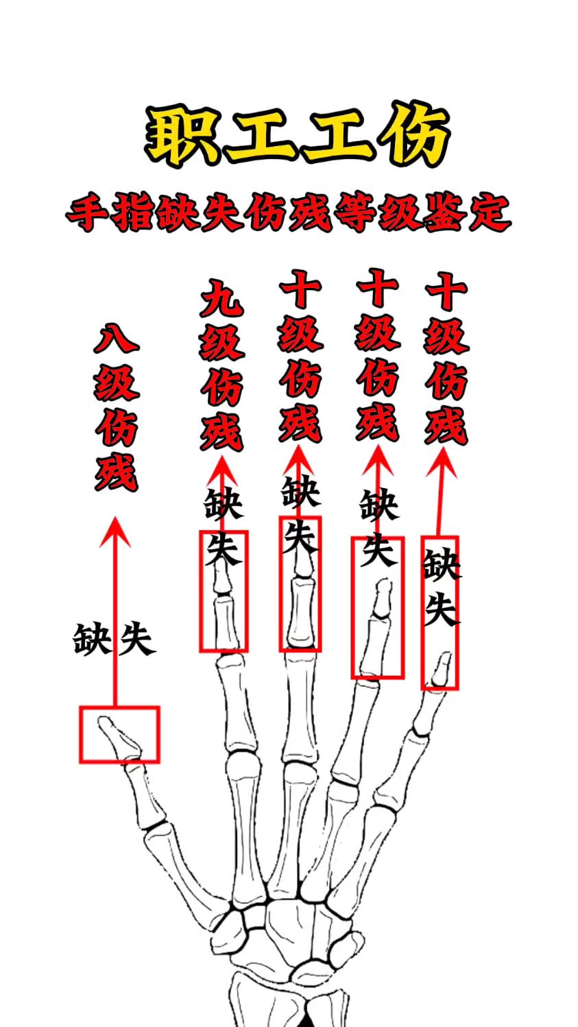 手指缺失分值图图片