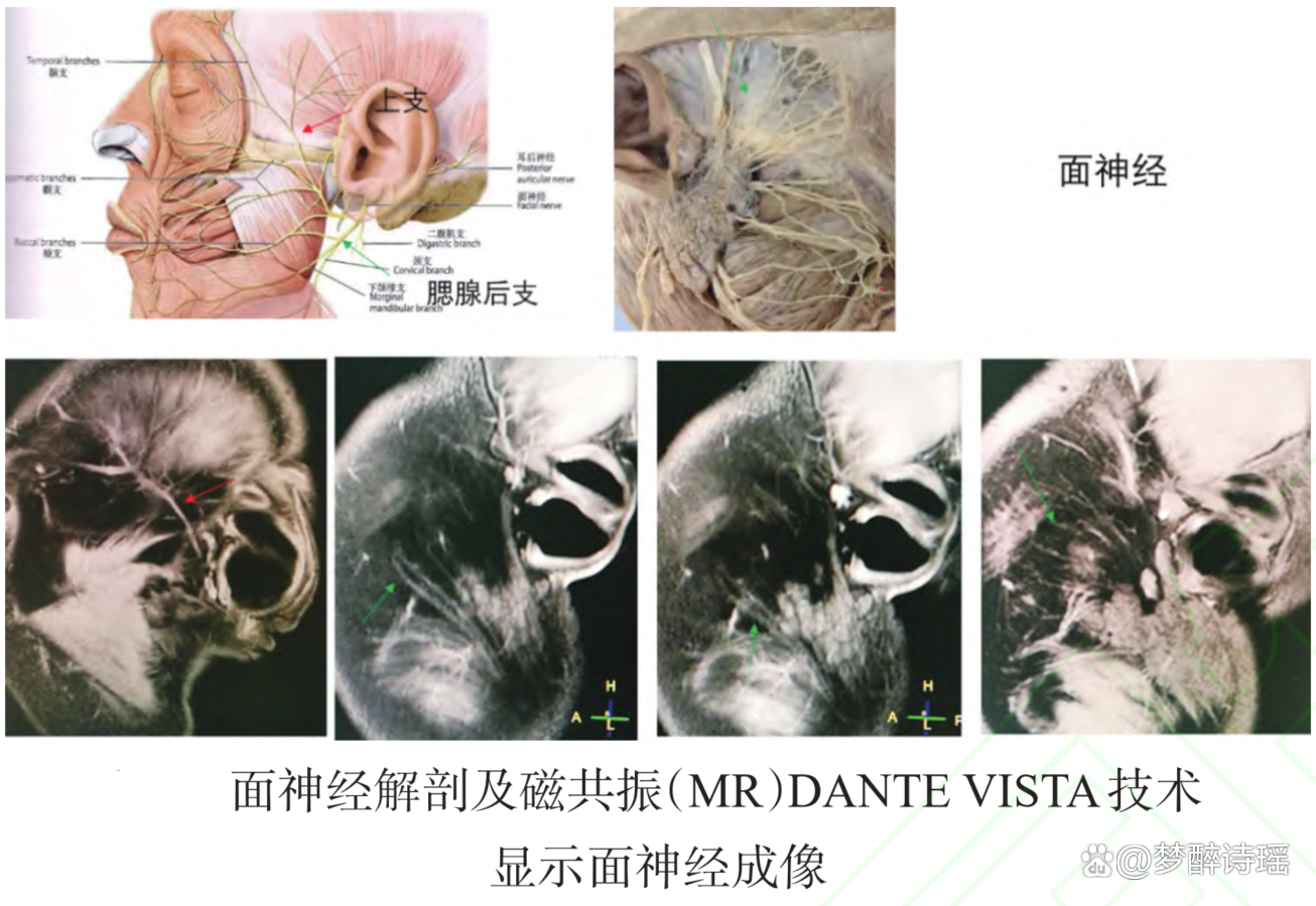 特发性面神经麻痹(面神经炎)神经修复治疗临床指南(大总结)