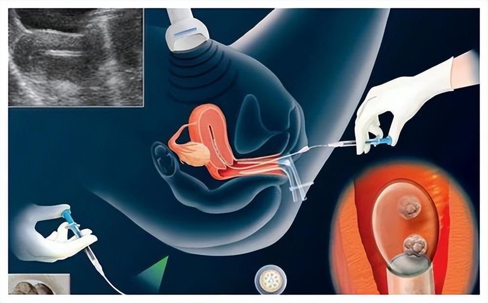 2015年西安43岁母亲将子宫移植给22岁女儿4年后创下医学奇迹
