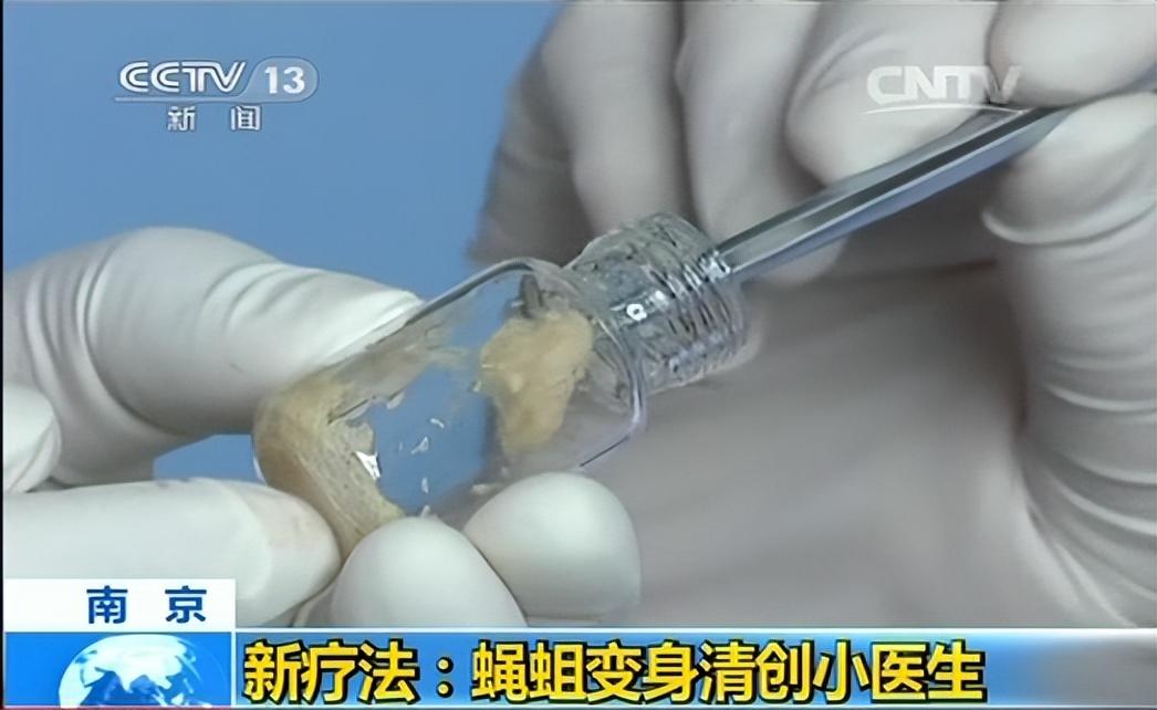 2011年山东男子下肢被烧伤为活命医生放10万蛆虫啃咬结局如何