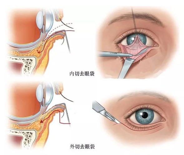 下睑内翻手术做法图解图片