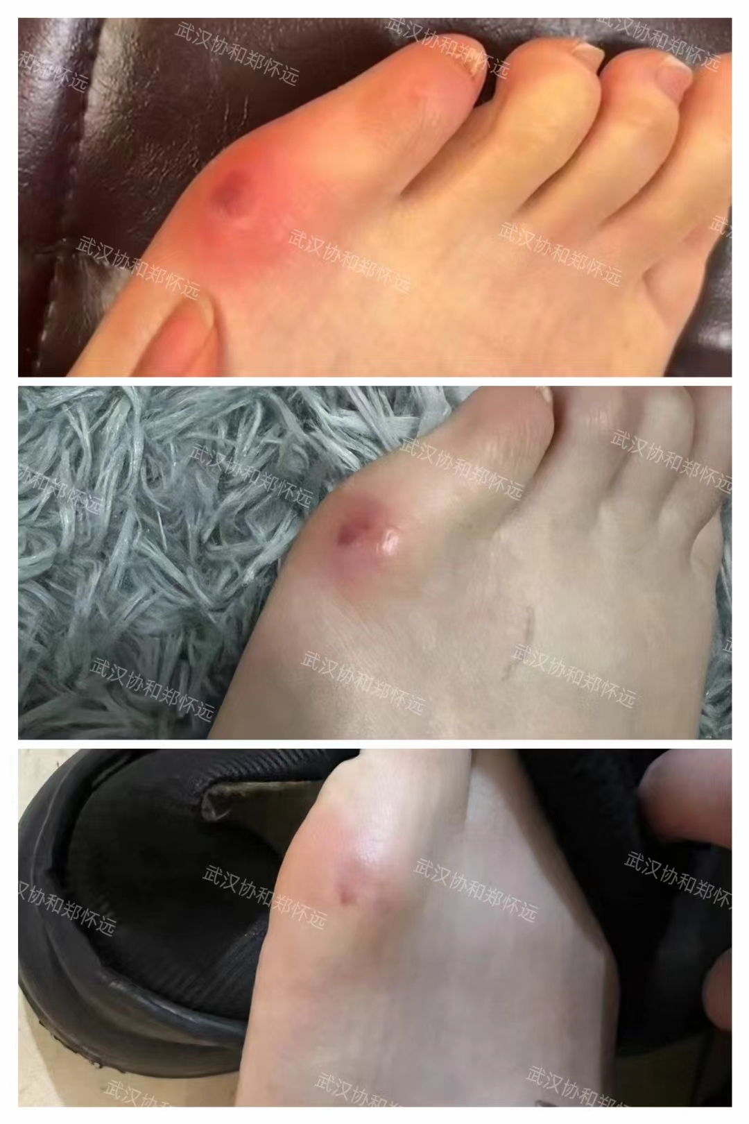 注意了:脚上的小指内翻跟拇外翻是一样的!