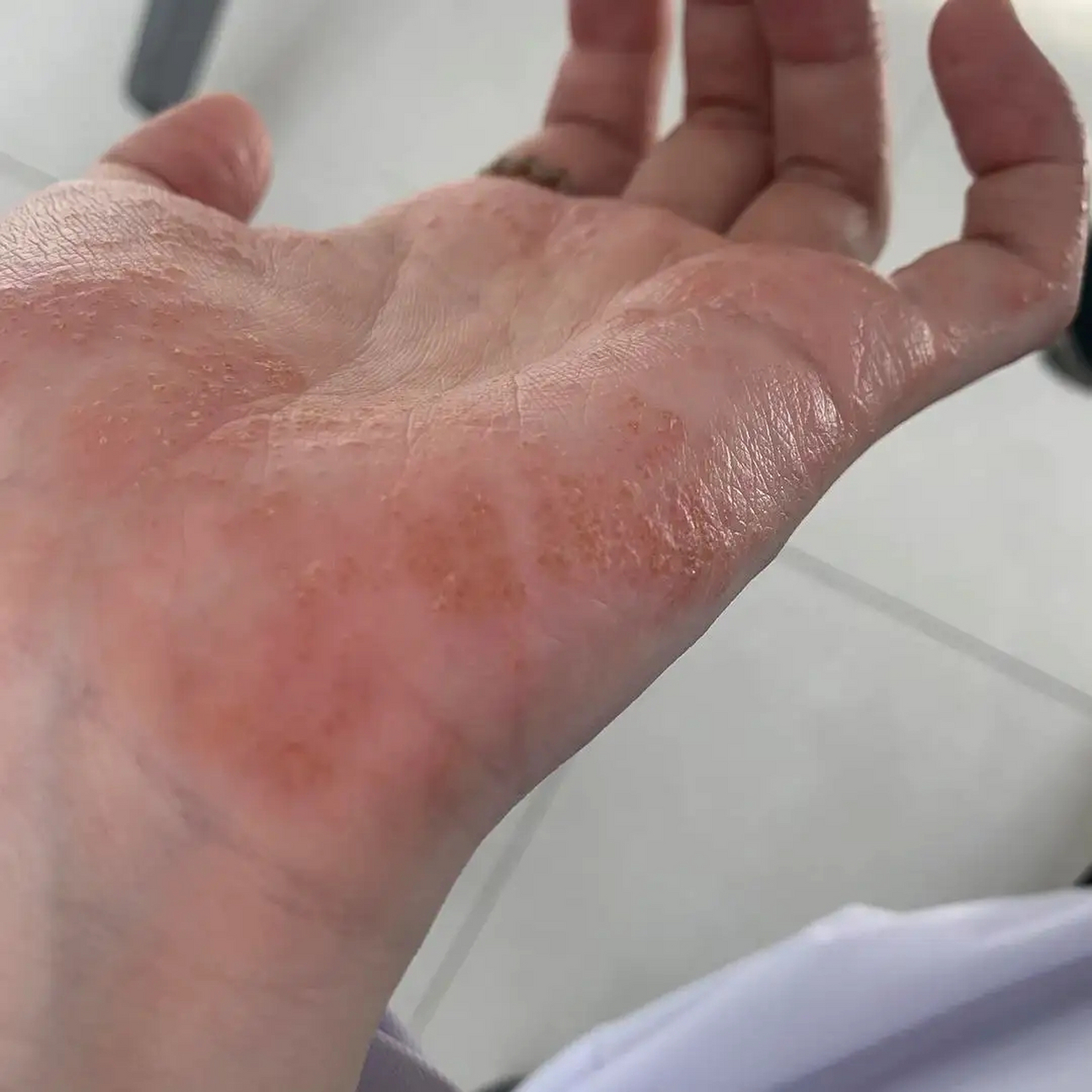 最近门诊来看汗疱疹的又多了起来,最近有个王先生,又开始手蜕皮了