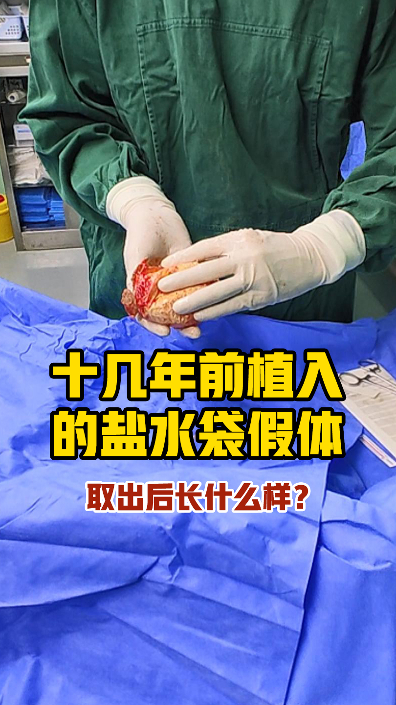 十几年前植入的盐水袋假体