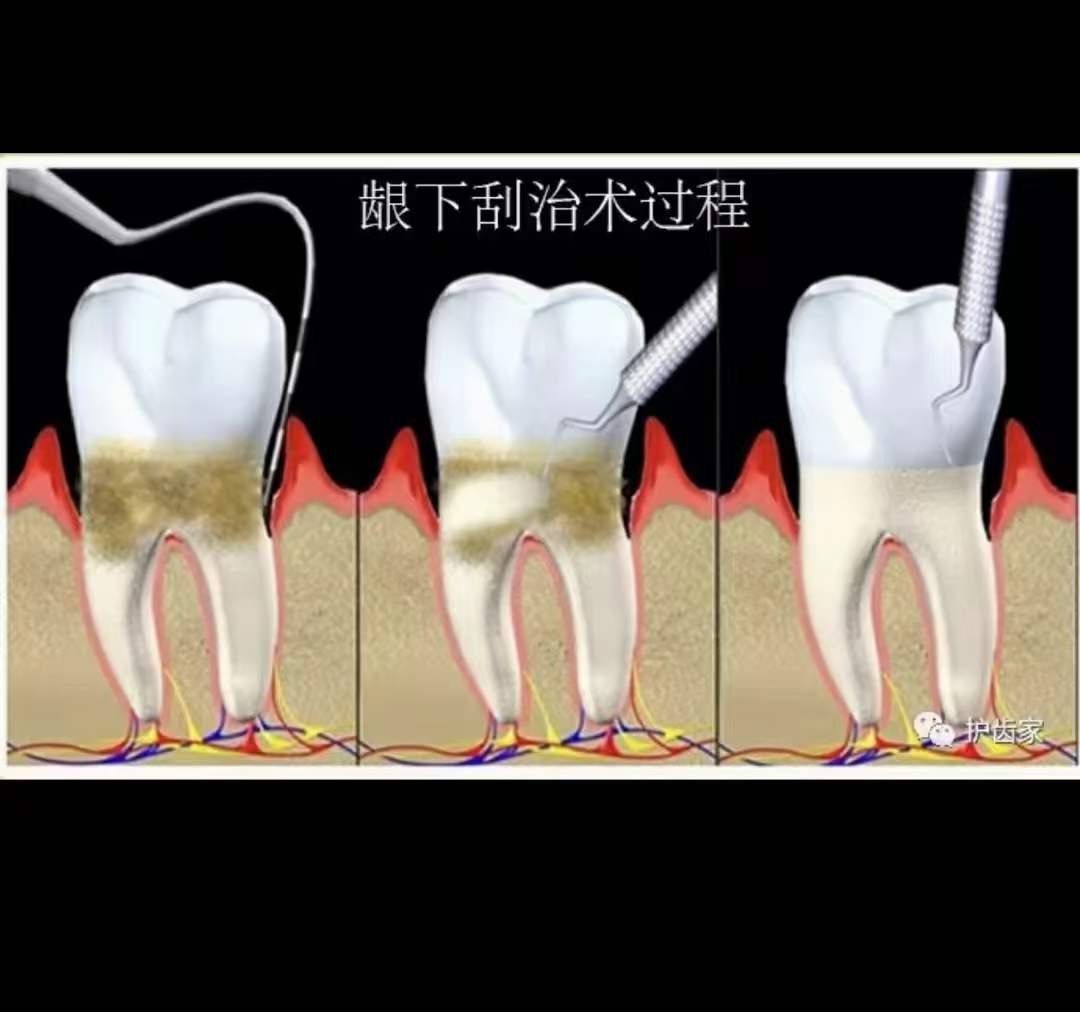 刮治器怎么区分图解图片