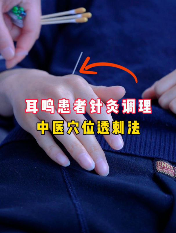 耳鸣患者针灸调理