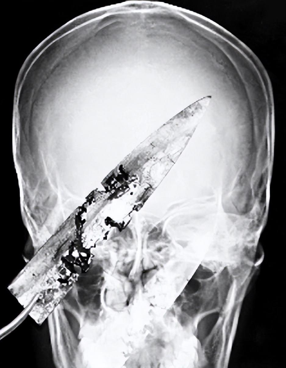 回顾女子给丈夫按摩导致丈夫吐血检查发现头部有把10厘米匕首