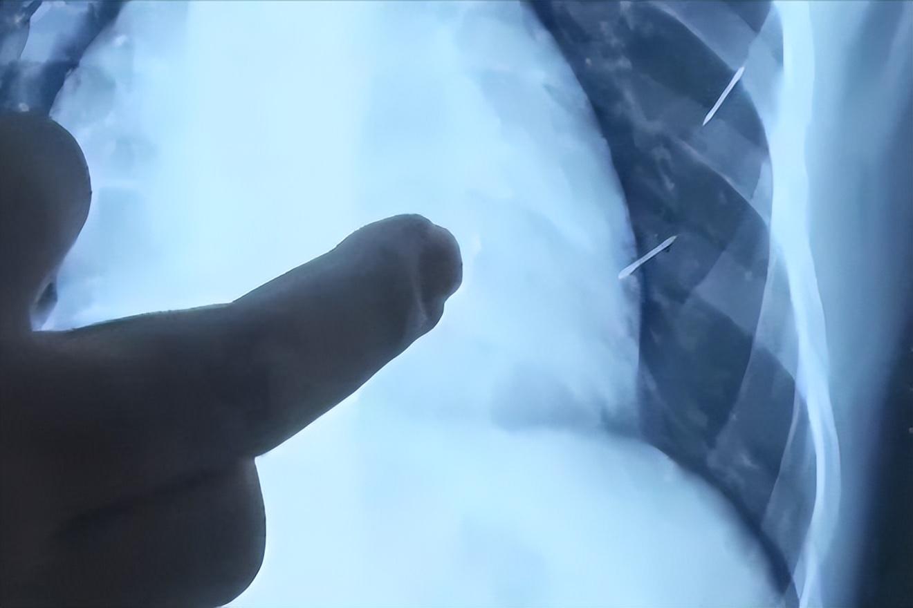 心脏已被扎的"千疮百孔",准备手术!