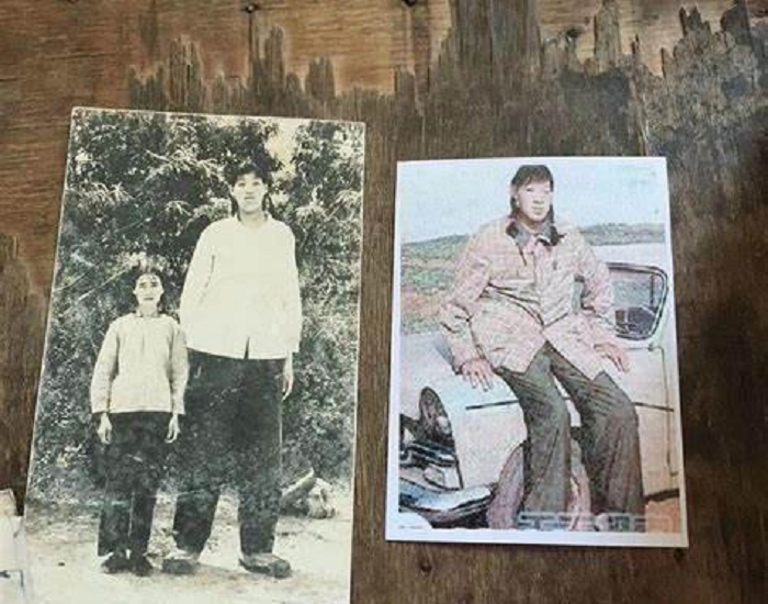 回顾女巨人曾金莲身高2米36却在18岁猝死遗体捐献科学研究