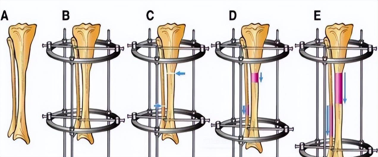 2014年20岁北京男孩李亚诺花16万断骨增高74厘米后来怎样