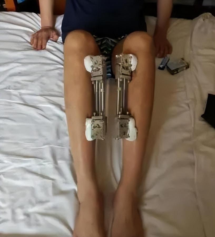 2014年20岁北京男孩李亚诺花16万断骨增高74厘米后来怎样