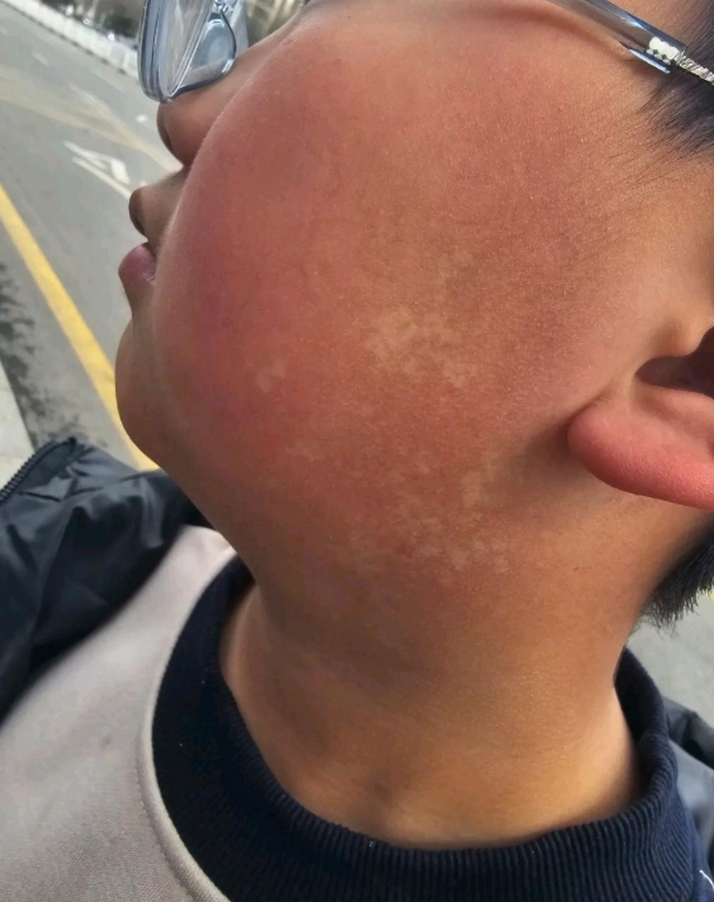 孩子脸上这些白点点是什么原因引起的?是不是被称为缺血斑?